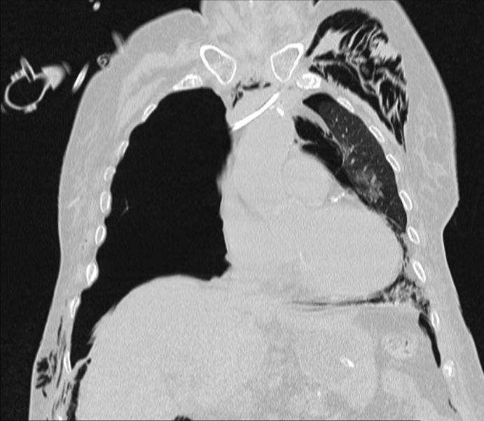 Barotrauma due to mechanical ventilation (Radiopaedia 28079-28336 Coronal lung window 40).jpg
