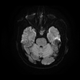 File:Basal cell carcinoma (periorbital) (Radiopaedia 55179-61559 Axial DWI 8).jpg