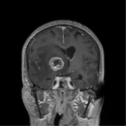 Basal ganglia metastasis (Radiopaedia 78928-91828 Coronal T1 C+ 30).png