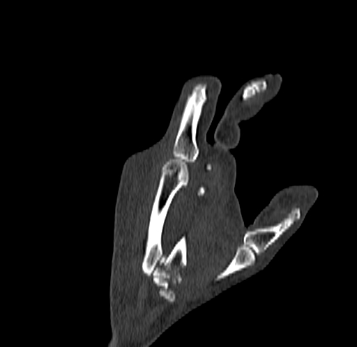 Base of 2nd metacarpal fracture (Radiopaedia 73741-84544 Coronal bone window 65).jpg