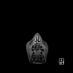Base of skull rhabdomyosarcoma (Radiopaedia 32196-33142 I 6).jpg