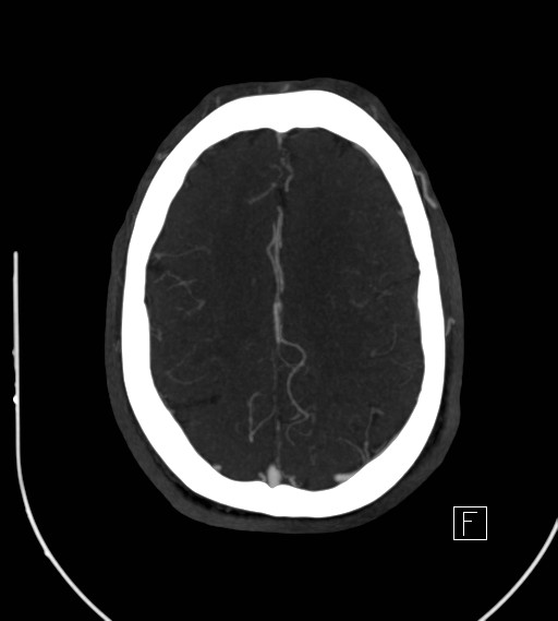 Basilar artery thrombosis (Radiopaedia 26986-27163 A 64).jpg