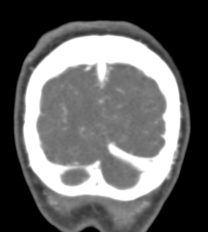 Basilar tip aneurysm with coiling (Radiopaedia 53912-60086 B 147).jpg