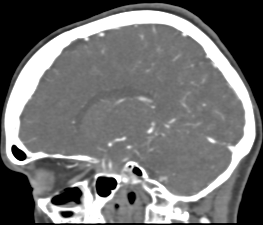 Basilar tip aneurysm with coiling (Radiopaedia 53912-60086 C 81).jpg