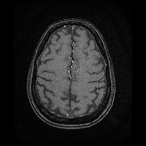Basilar top and left middle cerebral artery aneurysm (Radiopaedia 61965-70031 Axial MRA 134).jpg