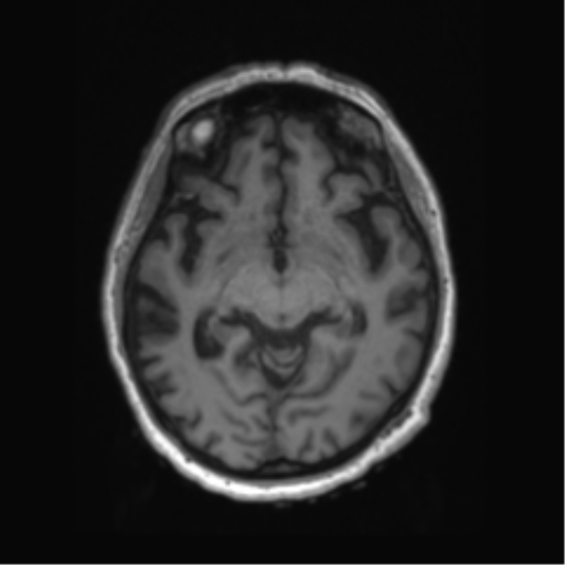 Behavioral variant frontotemporal dementia and late onset schizophrenia (Radiopaedia 52197-58083 Axial T1 60).png