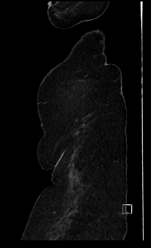 Below filter IVC thrombosis (Radiopaedia 58187-65266 C 145).jpg