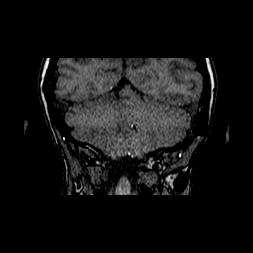 File:Berry aneurysm of the terminal internal carotid artery (Radiopaedia 88286-104918 Coronal TOF 94).jpg