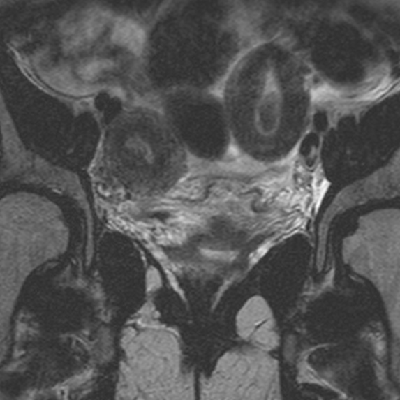 File:Bicornuate uterus (Radiopaedia 24677-24949 Coronal T2 4).jpg