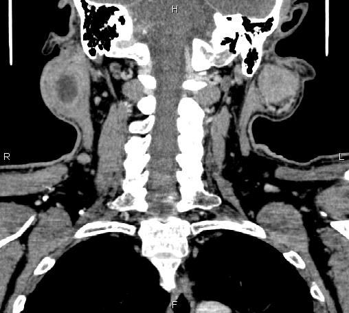 File:Bilateral Warthin tumors (Radiopaedia 84034-99263 C 36).jpg