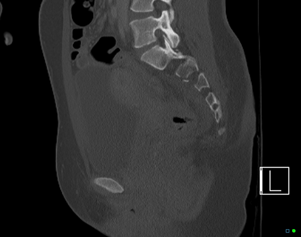 File:Bilateral acetabular fractures (Radiopaedia 79272-92308 Sagittal bone window 42).jpg
