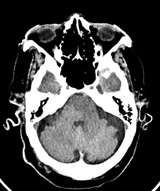 Bilateral acute on chronic subdural hematomas (Radiopaedia 78466-91146 Axial non-contrast 18).jpg