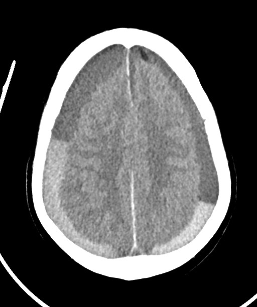Bilateral acute on chronic subdural hematomas (Radiopaedia 78466-91146 Axial non-contrast 40).jpg