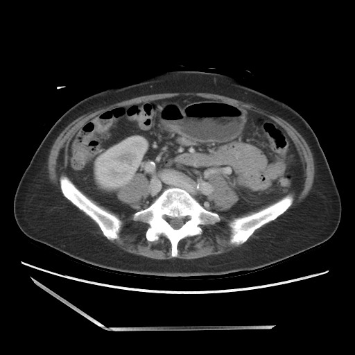File:Bilateral adrenal granulocytic sarcomas (chloromas) (Radiopaedia 78375-91007 A 73).jpg