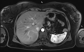 Bilateral adrenal myelolipoma (Radiopaedia 63058-71537 Axial T1 C+ fat sat 25).jpg