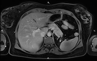 File:Bilateral adrenal myelolipoma (Radiopaedia 63058-71537 H 28).jpg