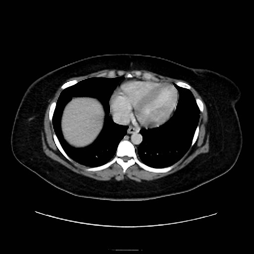 Bilateral adrenal thrombosis (Radiopaedia 58182-65256 A 2).jpg