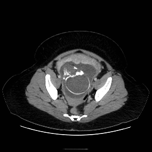 Bilateral adrenal thrombosis (Radiopaedia 58182-65256 A 66).jpg