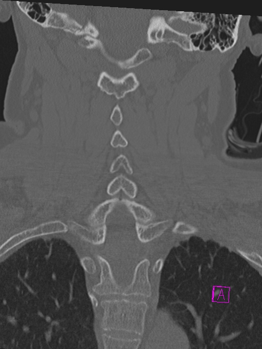Bilateral atlanto-occipital assimilation (Radiopaedia 28350-28603 Coronal bone window 29).jpg