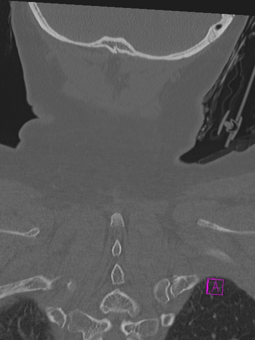 Bilateral atlanto-occipital assimilation (Radiopaedia 28350-28603 Coronal bone window 47).jpg