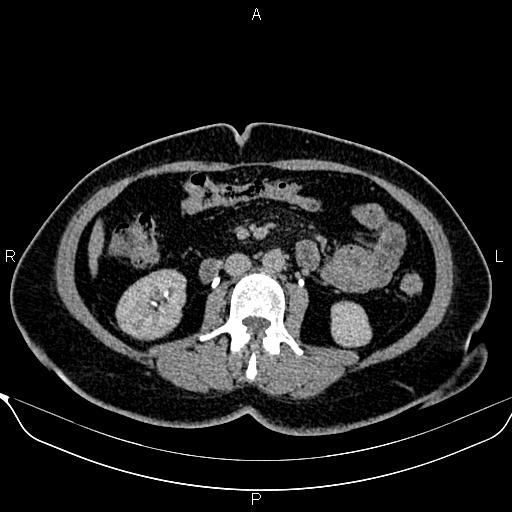 Bilateral benign adrenal adenomas (Radiopaedia 86912-103124 Axial C+ delayed 75).jpg