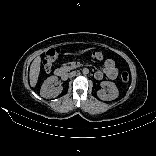 Bilateral benign adrenal adenomas (Radiopaedia 86912-103124 Axial non-contrast 50).jpg