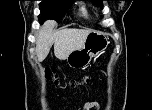 Bilateral benign adrenal adenomas (Radiopaedia 86912-103124 D 7).jpg