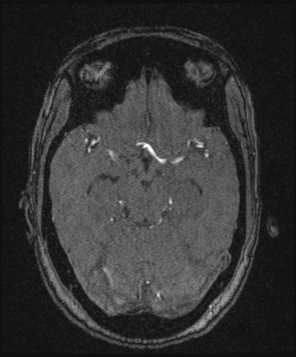 Bilateral carotid body tumors and right glomus jugulare tumor (Radiopaedia 20024-20060 Axial MRA 73).jpg
