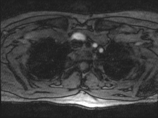 File:Bilateral carotid body tumors and right jugular paraganglioma (Radiopaedia 20024-20060 Axial 287).jpg