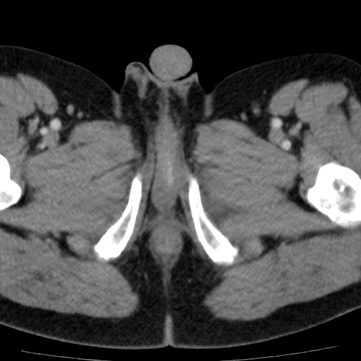File:Bilateral direct inguinal herniae (Radiopaedia 17016-16719 B 32).jpg