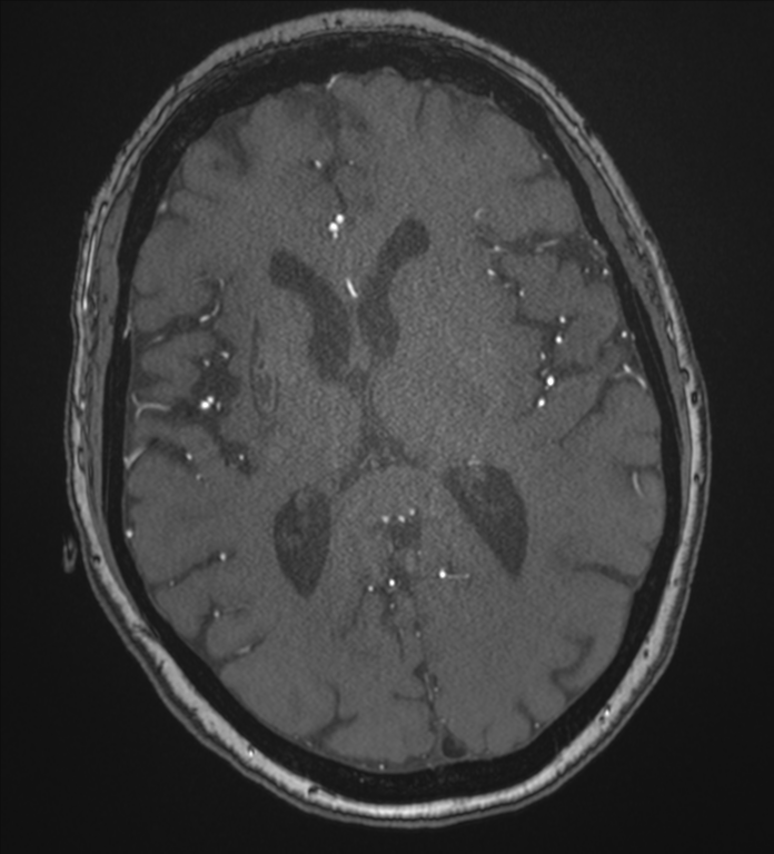 Bilateral fetal posterior communicating arteries (Radiopaedia 41286-44102 Axial MRA 121).png