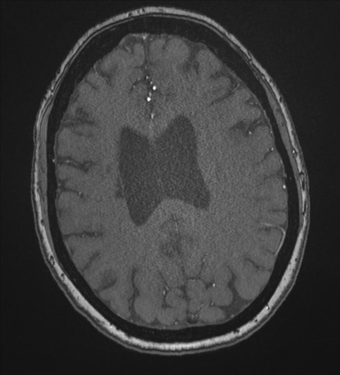Bilateral fetal posterior communicating arteries (Radiopaedia 41286-44102 Axial MRA 151).png