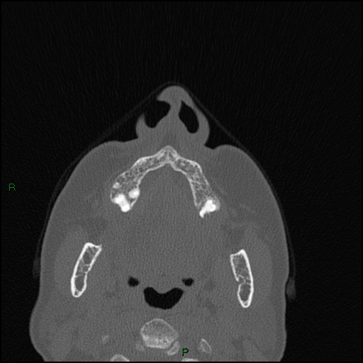 Bilateral frontal mucoceles (Radiopaedia 82352-96454 Axial bone window 249).jpg