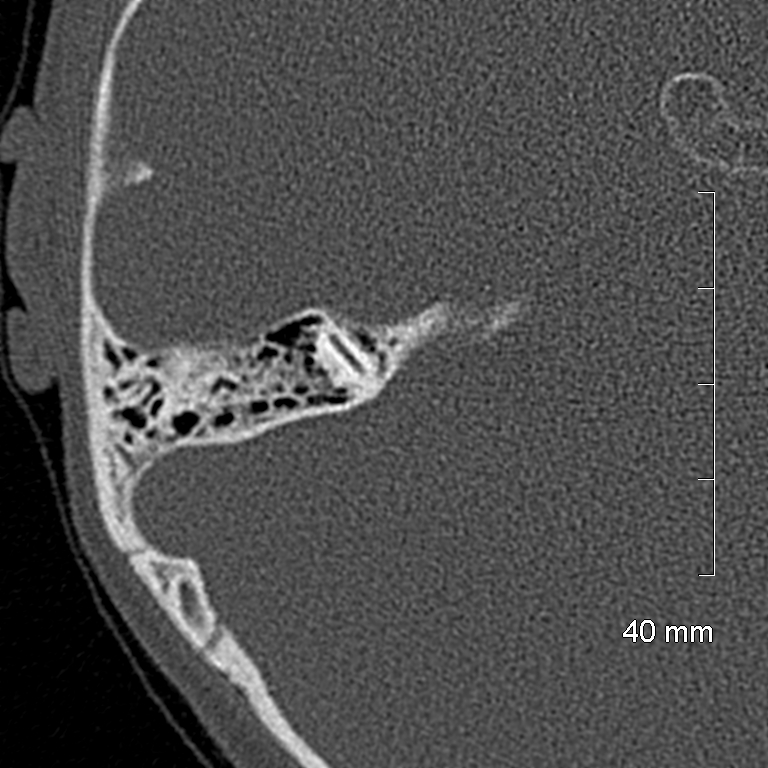 Bilateral grommets (Radiopaedia 47710-52404 Axial bone window 58).jpg