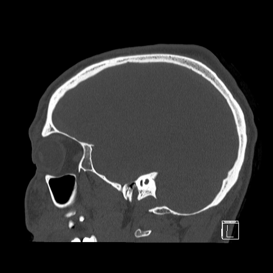 Bilateral occipital condyle fracture (type 2) (Radiopaedia 87675-104089 Sagittal bone window 85).jpg