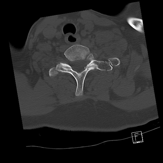Bilateral occipital condyle fractures (type 3) (Radiopaedia 87672-104086 Axial bone window 66).jpg
