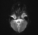 File:Bilateral optic pathway gliomas (Radiopaedia 40013-42514 Axial DWI 1).jpg