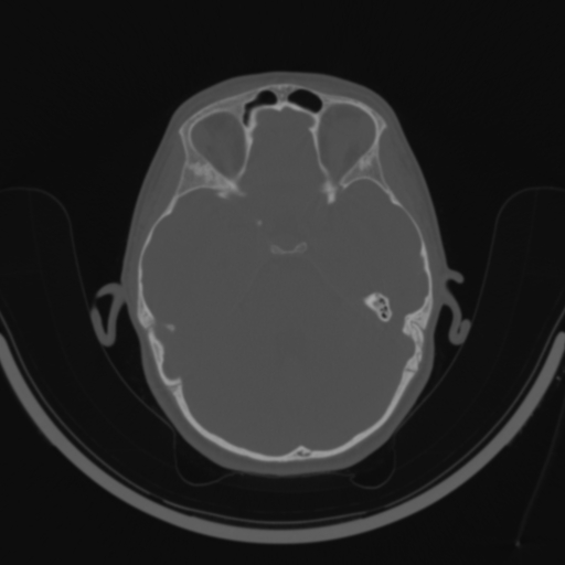 Bilateral otosclerosis (Radiopaedia 57237-64157 C 69).jpg
