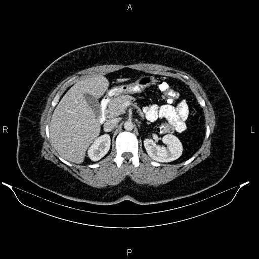 Bilateral ovarian dermoid cysts (Radiopaedia 85785-101603 A 39).jpg