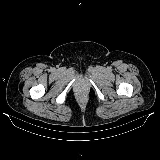 Bilateral ovarian dermoid cysts (Radiopaedia 85785-101603 Axial C+ delayed 95).jpg
