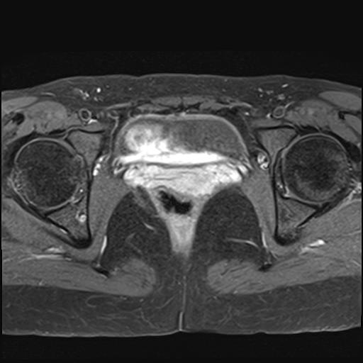 File:Bilateral ovarian endometriomas (Radiopaedia 87085-103347 Axial T1 C+ fat sat 17).jpg