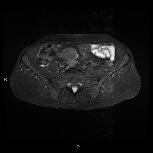 File:Bilateral ovarian fibroma (Radiopaedia 44568-48293 Axial STIR 4).jpg