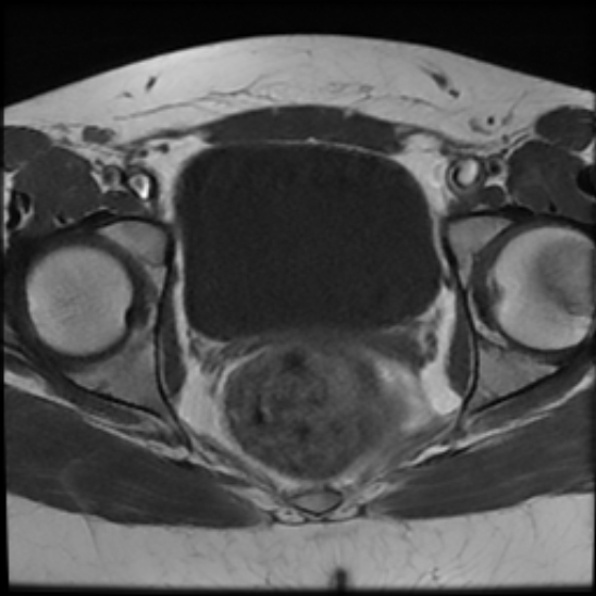 File:Bilateral ovarian fibrothecomas - adolescent (Radiopaedia 86604-102707 Axial T1 22).jpg