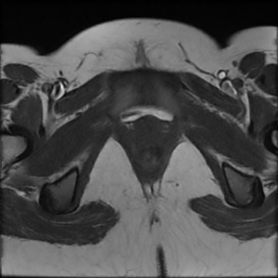 File:Bilateral ovarian fibrothecomas - adolescent (Radiopaedia 86604-102707 Axial T1 28).jpg