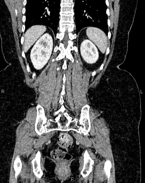 Bilateral ovarian serous cystadenocarcinoma (Radiopaedia 86062-101989 D 42).jpg