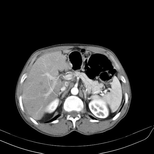 Bilateral parotid gland lymphoma (Radiopaedia 21038-20969 A 54).jpg