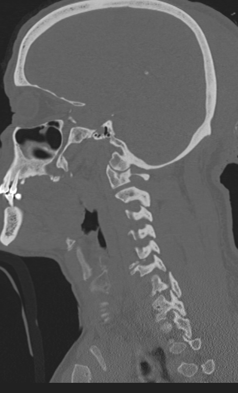Bilateral perched facet joint (Radiopaedia 63149-71669 Sagittal bone window 49).jpg