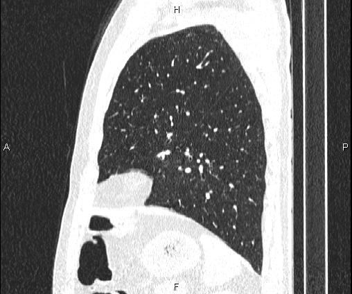 Bilateral pulmonary AVM (Radiopaedia 83134-97505 Sagittal lung window 85).jpg