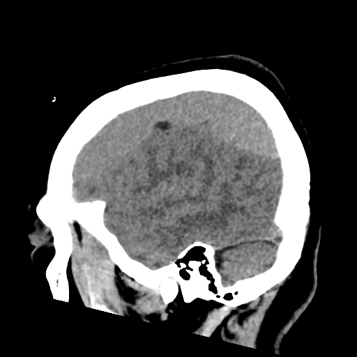 File:Bilateral subacute subdural hematoma (Radiopaedia 69240-79018 C 10).jpg