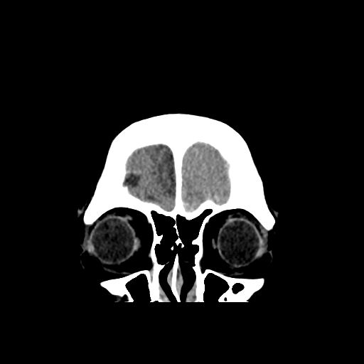 Bilateral subacute subdural hematoma (Radiopaedia 69240-79018 Coronal non-contrast 6).jpg